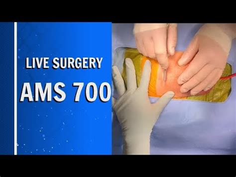 As one of the world's top urological surgeons, Dr. . Ams 700 lgx before and after pics
